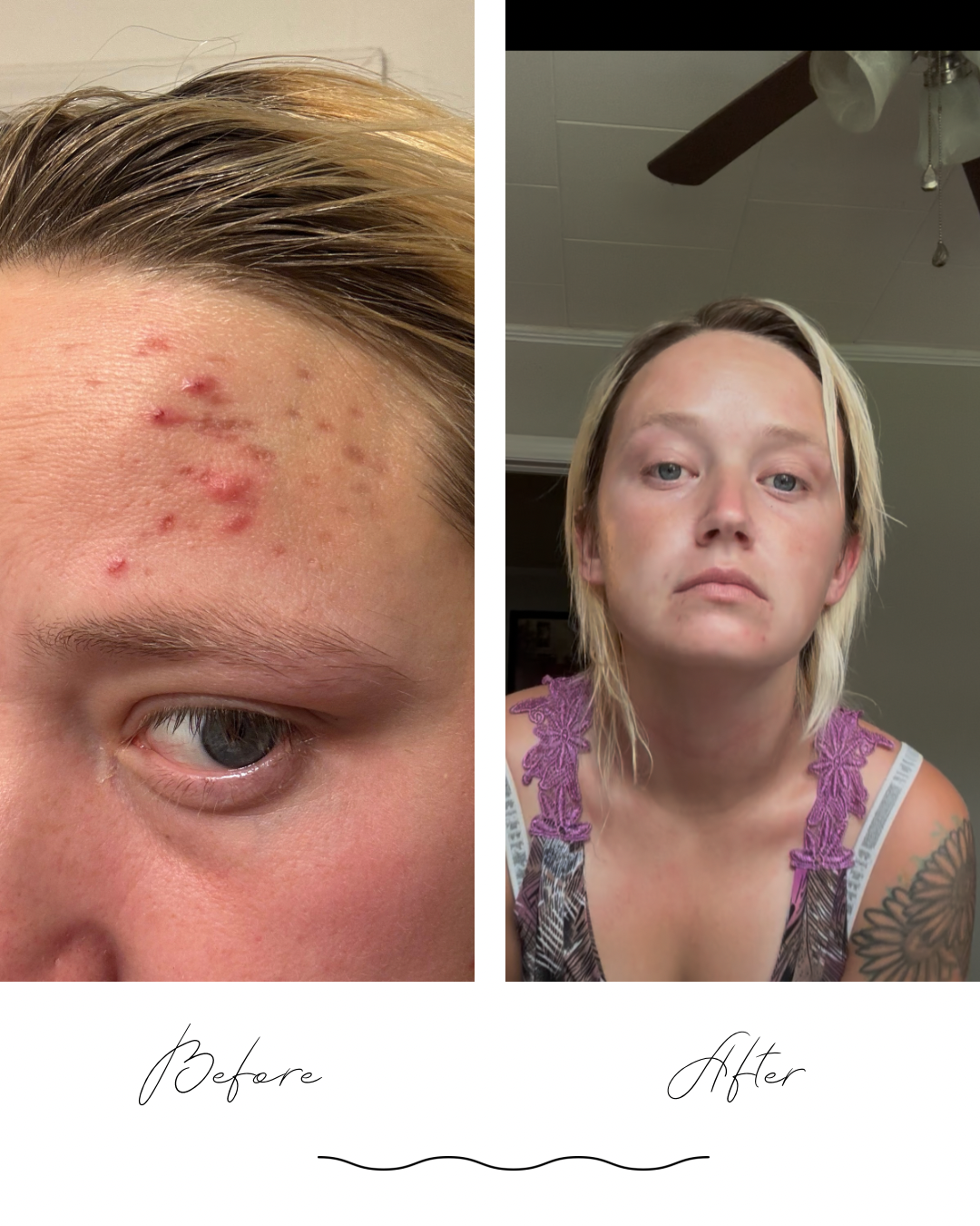 Acne Away Natural Skincare Routine for acne prone and sensitive skin.